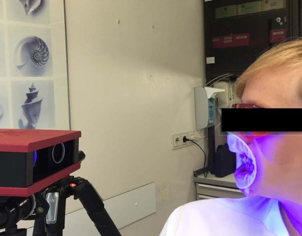 Escaneo de una mandibula humana realizado por el ATOS Core de GOM con aplicacines en la industria maxirofacial
